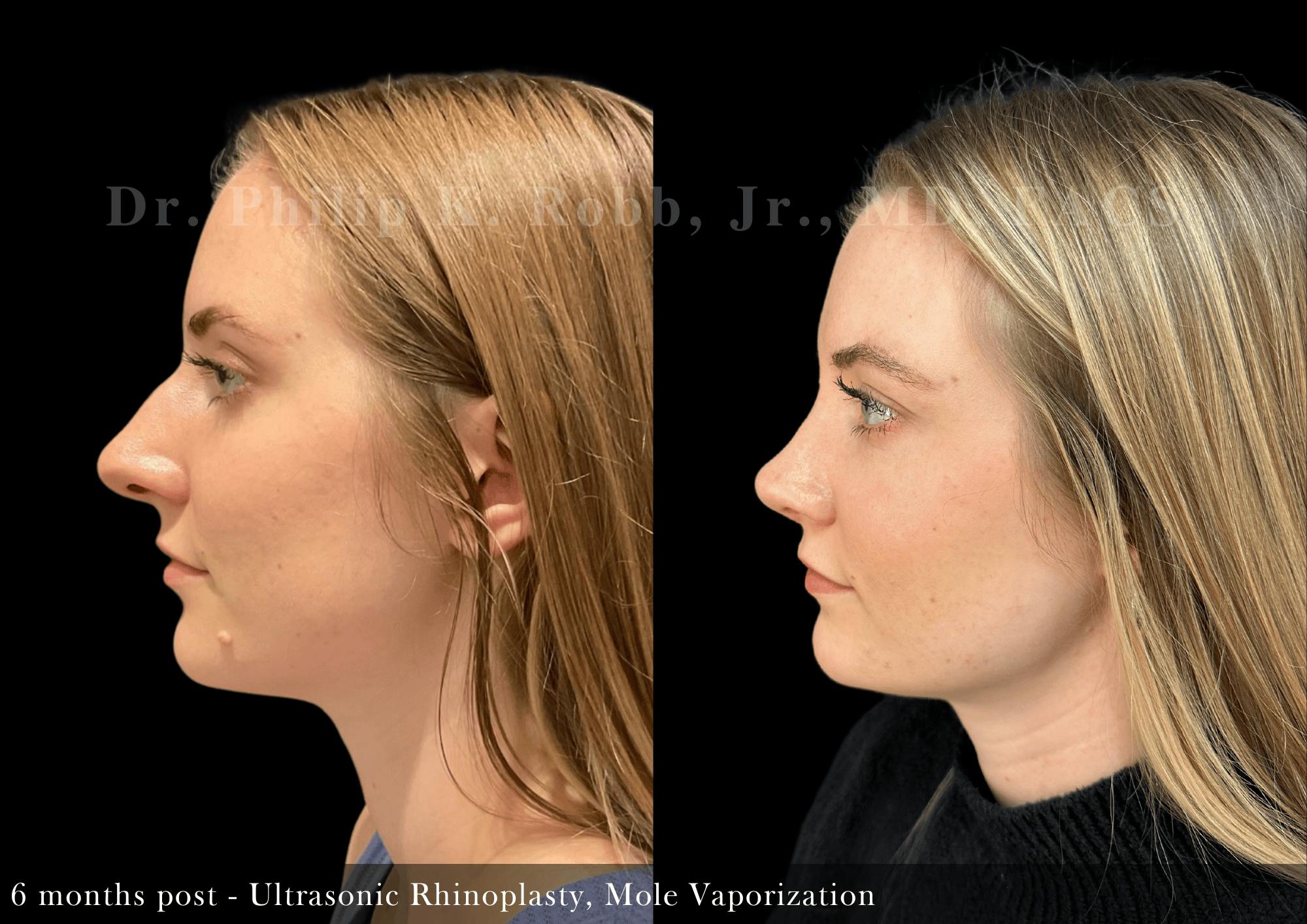 Nose Before & After Gallery - Patient 301015 - Image 4