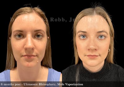 Face Before & After Gallery - Patient 213886 - Image 1