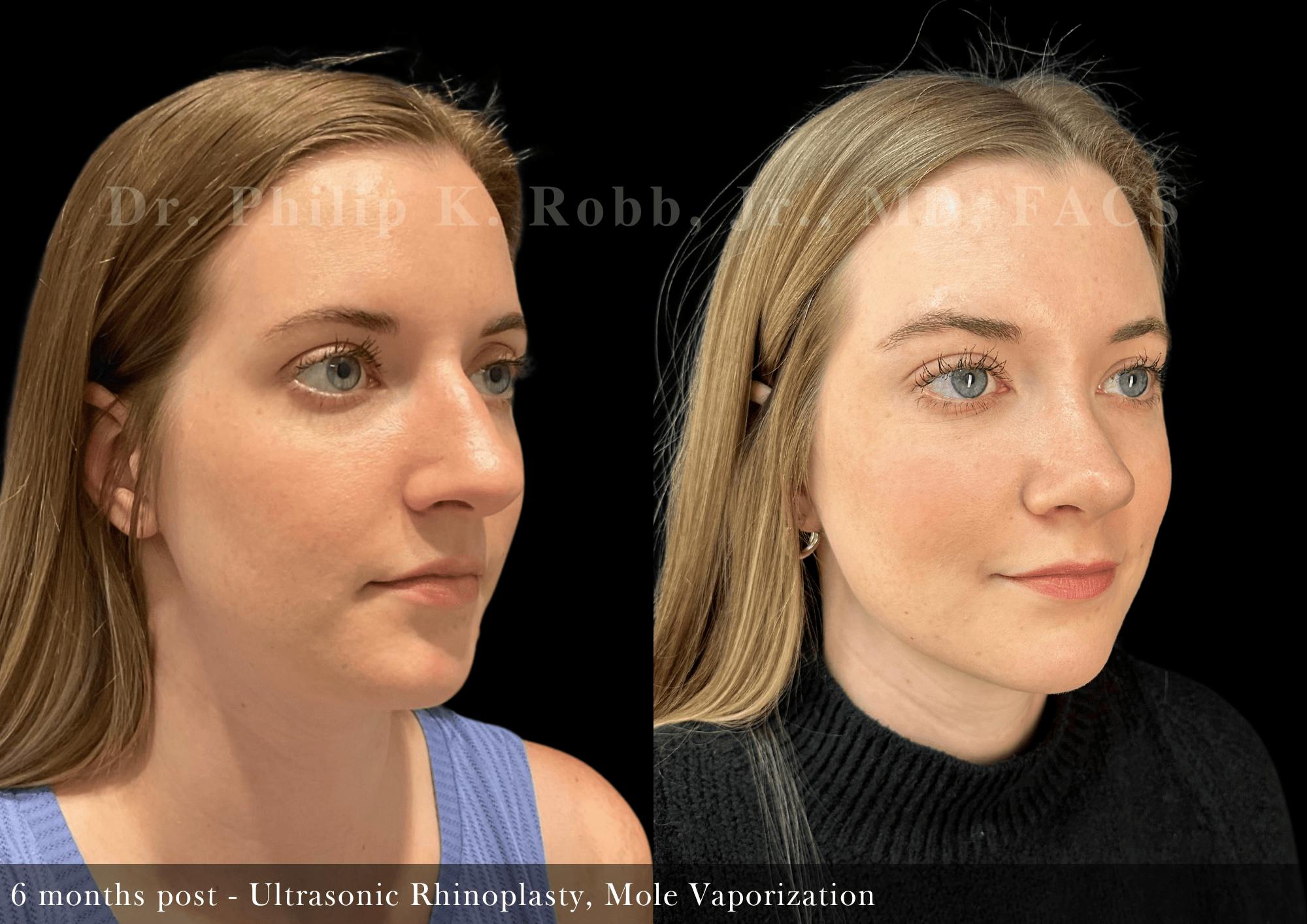 Face Before & After Gallery - Patient 213886 - Image 4