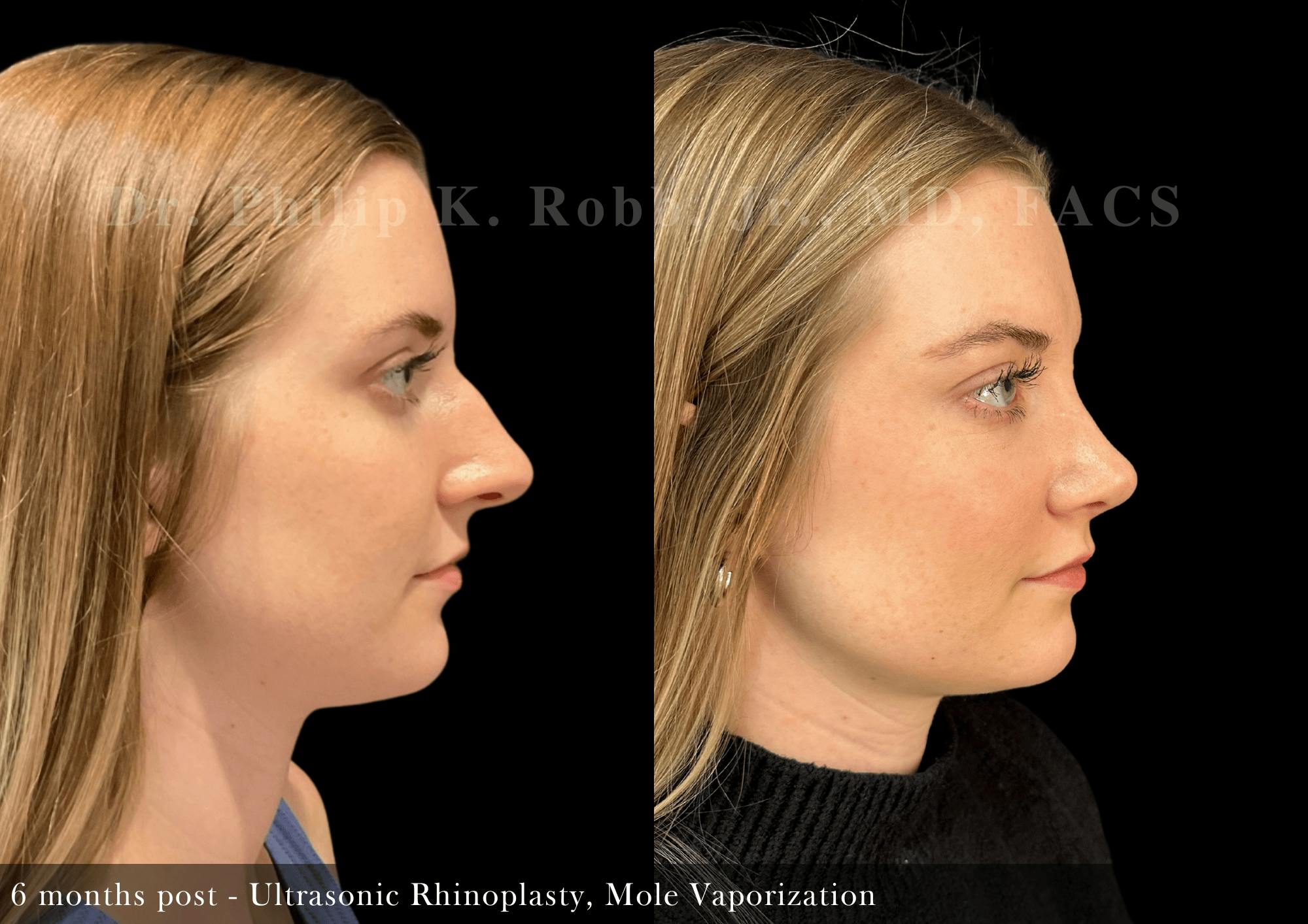 Nose Before & After Gallery - Patient 301015 - Image 1