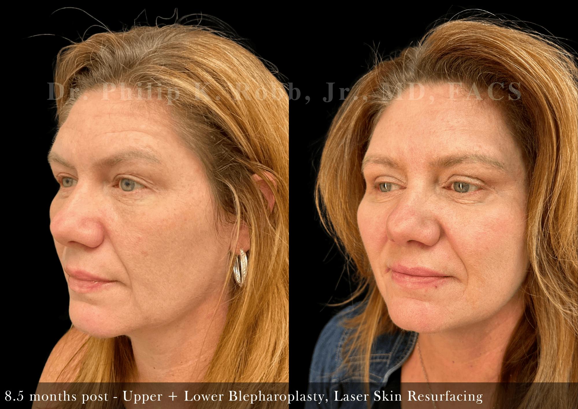 Face Before & After Gallery - Patient 332453 - Image 2
