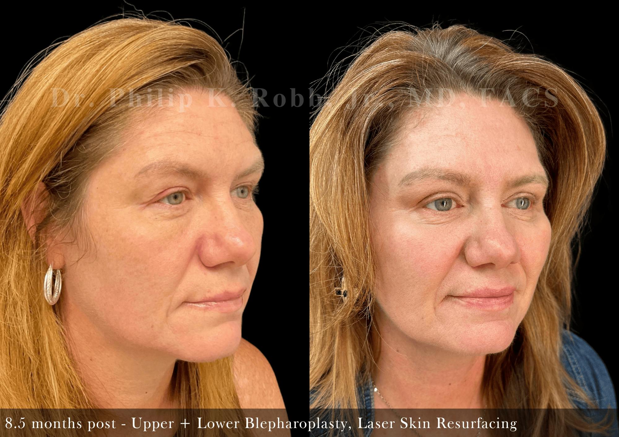 Face Before & After Gallery - Patient 332453 - Image 3