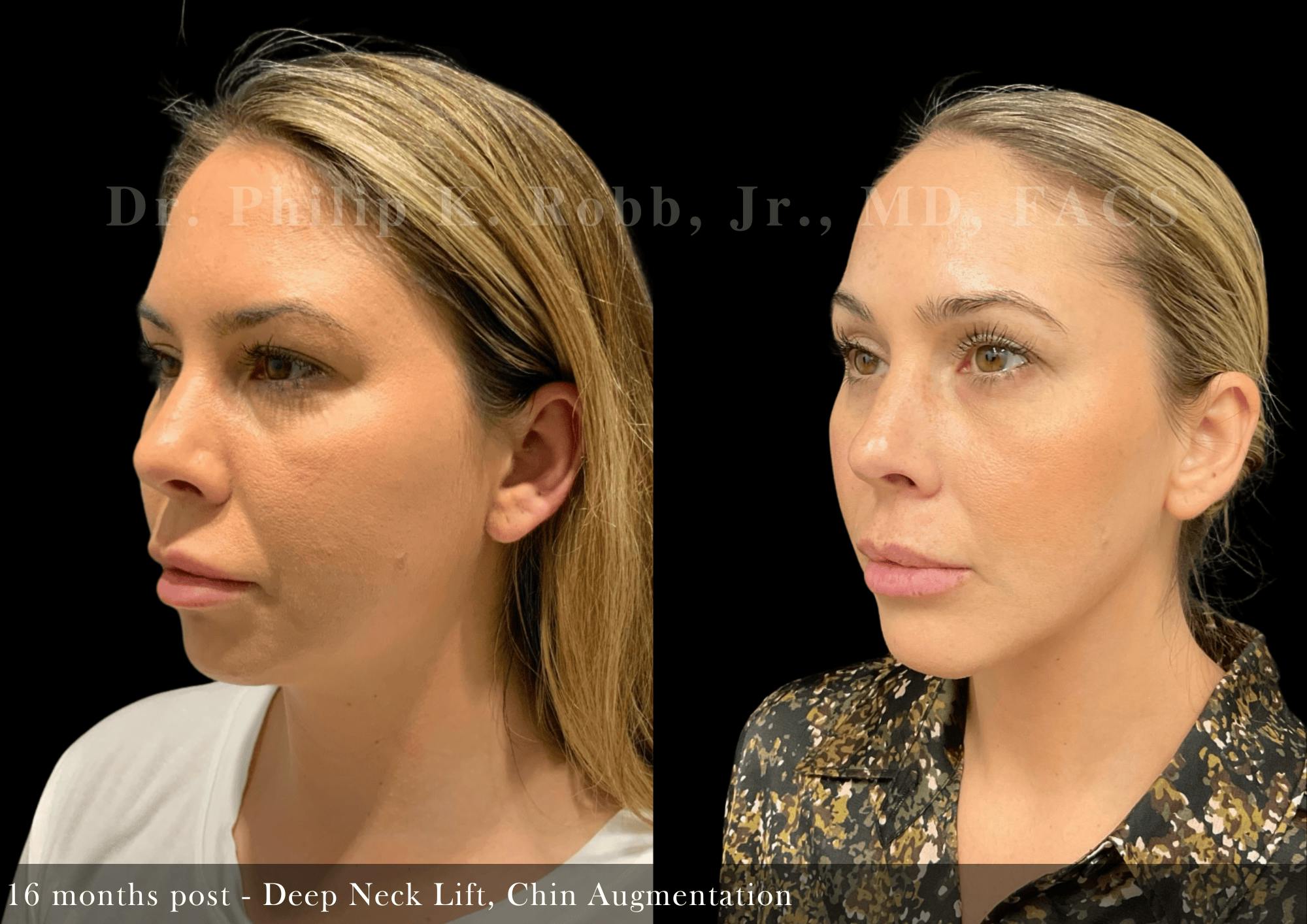 Face Before & After Gallery - Patient 340775 - Image 5