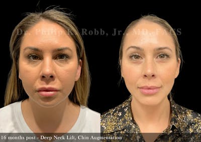 Face Before & After Gallery - Patient 340775 - Image 1