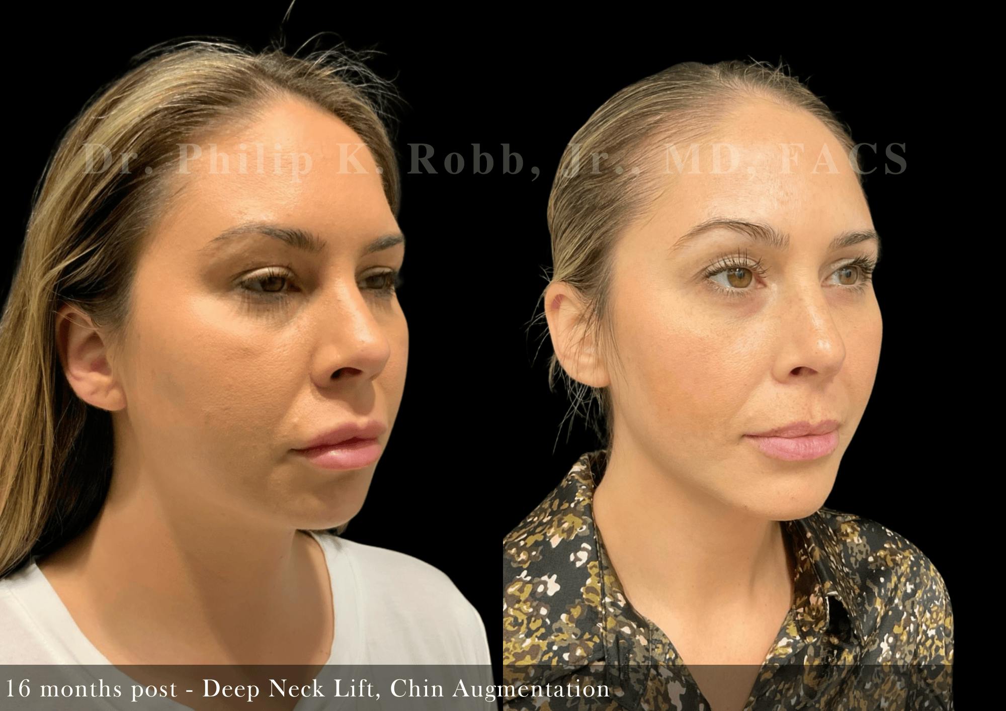Face Before & After Gallery - Patient 340775 - Image 2
