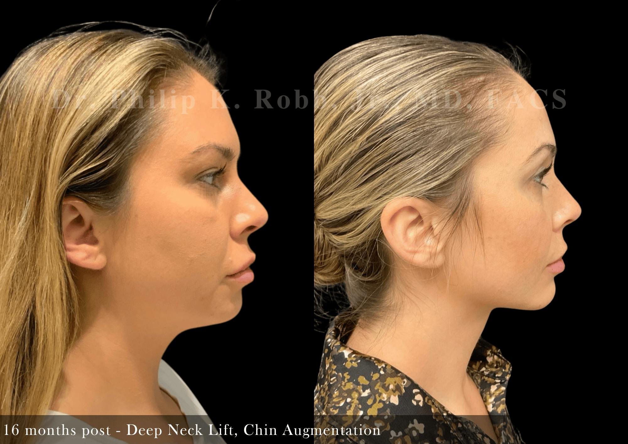 Face Before & After Gallery - Patient 340775 - Image 3