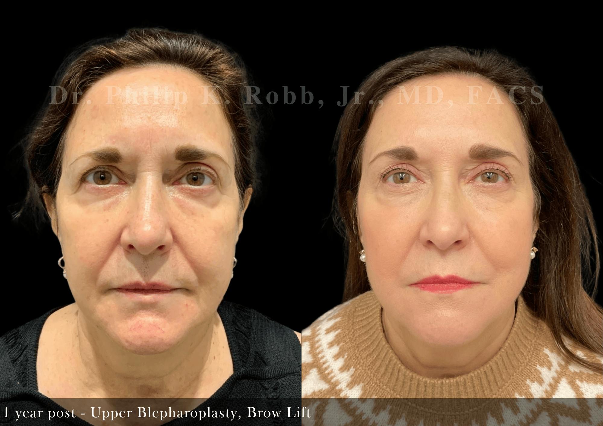 Face Before & After Gallery - Patient 606370 - Image 1
