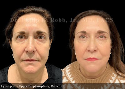 Face Before & After Gallery - Patient 606370 - Image 1