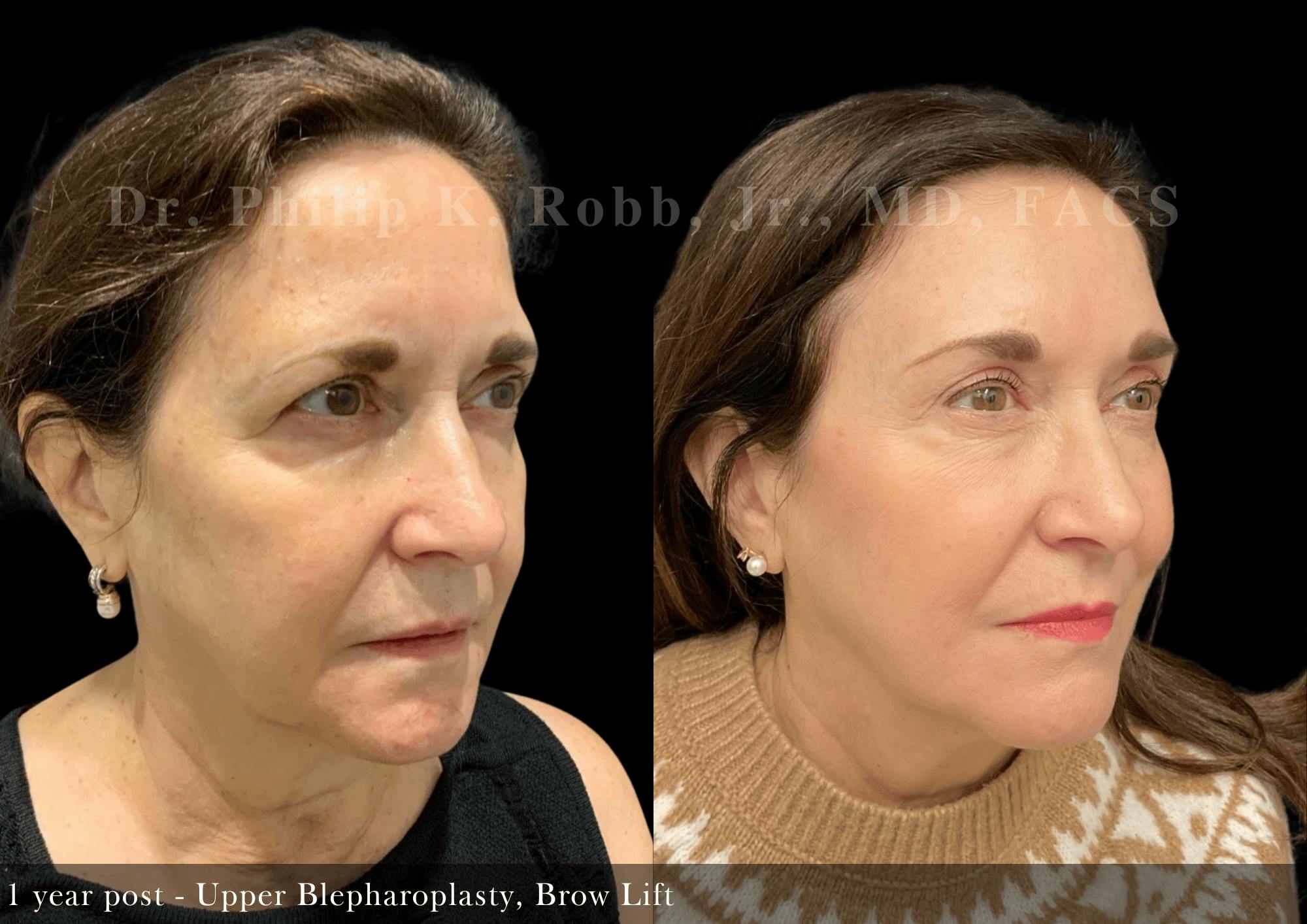 Face Before & After Gallery - Patient 606370 - Image 3