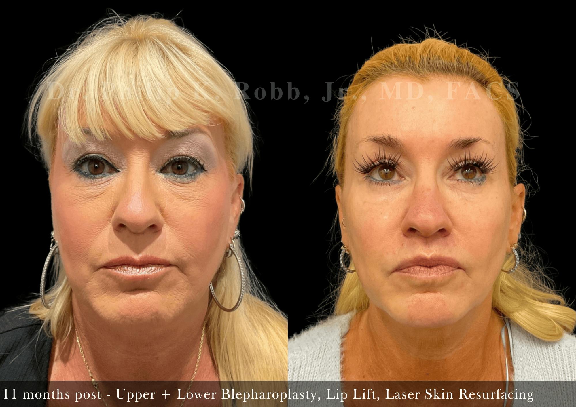 Face Before & After Gallery - Patient 374238 - Image 1