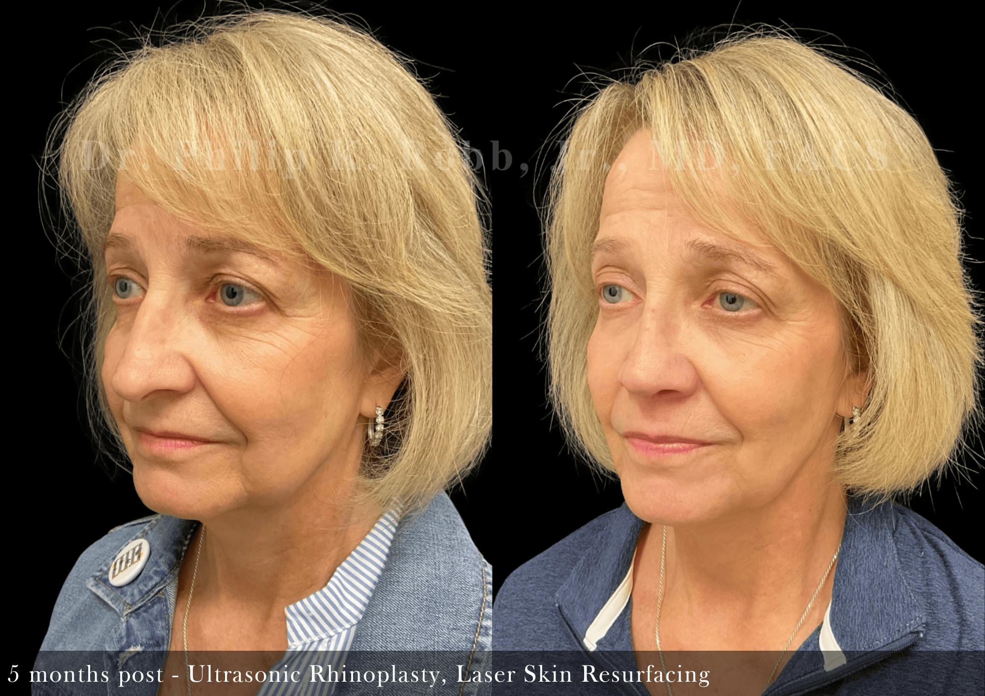 Face Before & After Gallery - Patient 429040 - Image 5