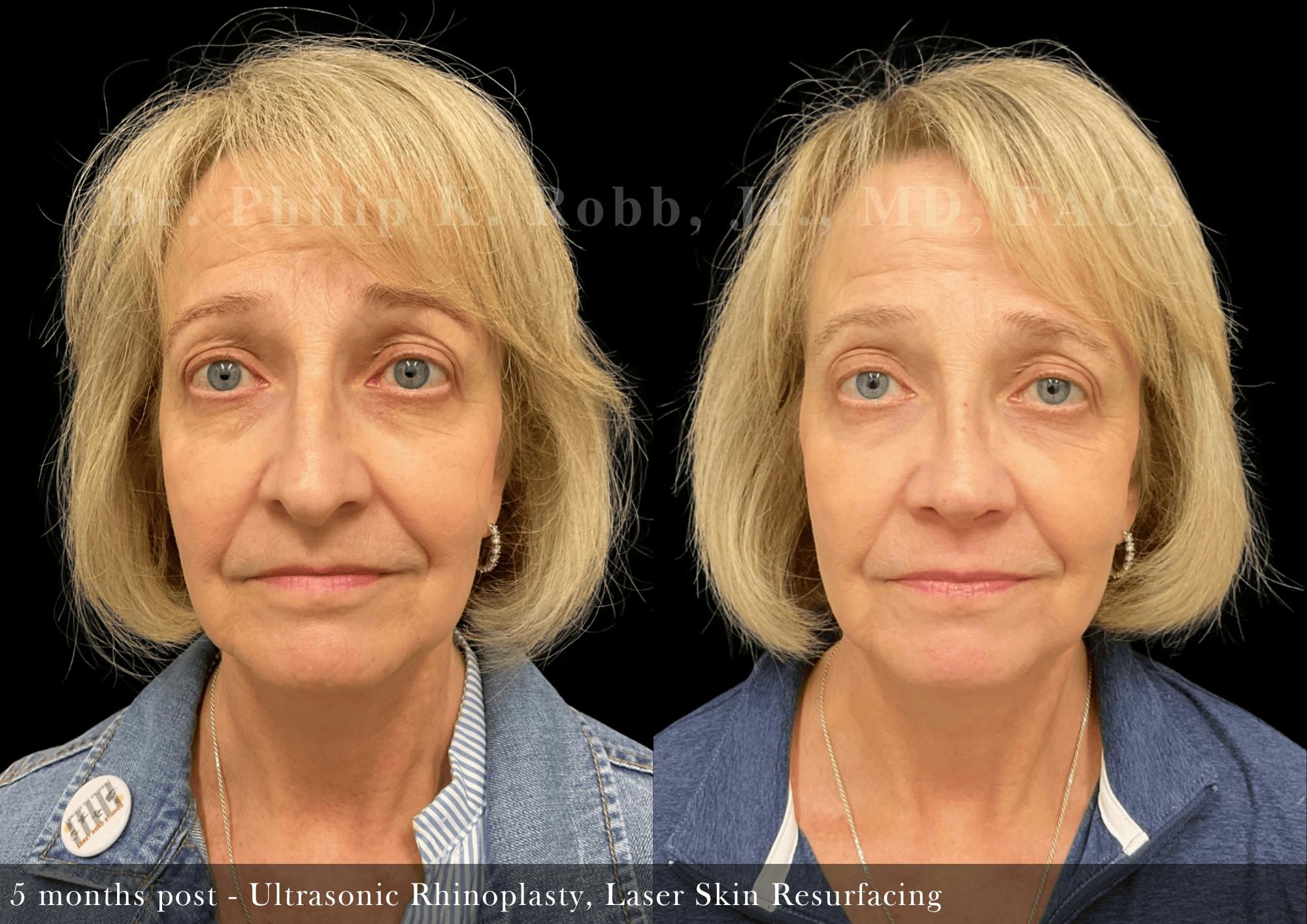 Face Before & After Gallery - Patient 429040 - Image 1