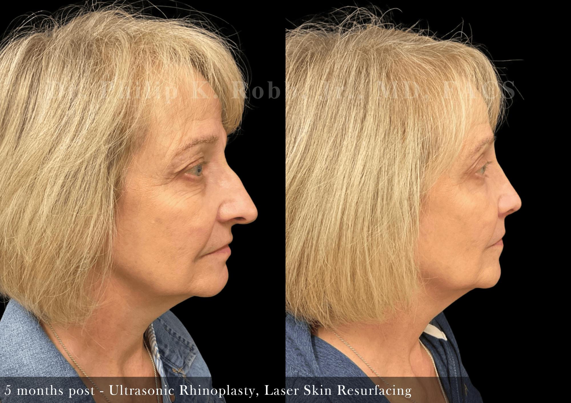 Nose Before & After Gallery - Patient 186896 - Image 1