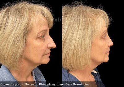 Nose Before & After Gallery - Patient 186896 - Image 1