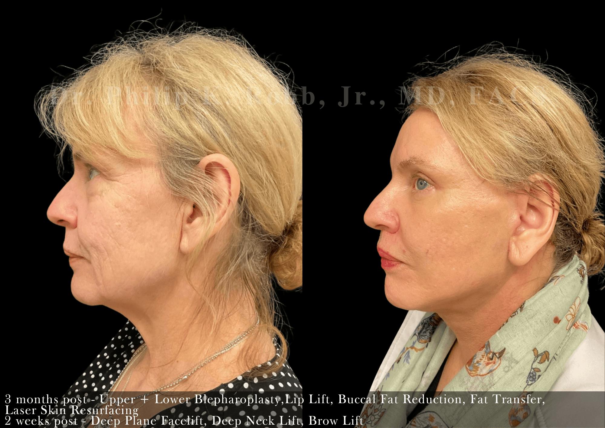 Face Before & After Gallery - Patient 525707 - Image 5