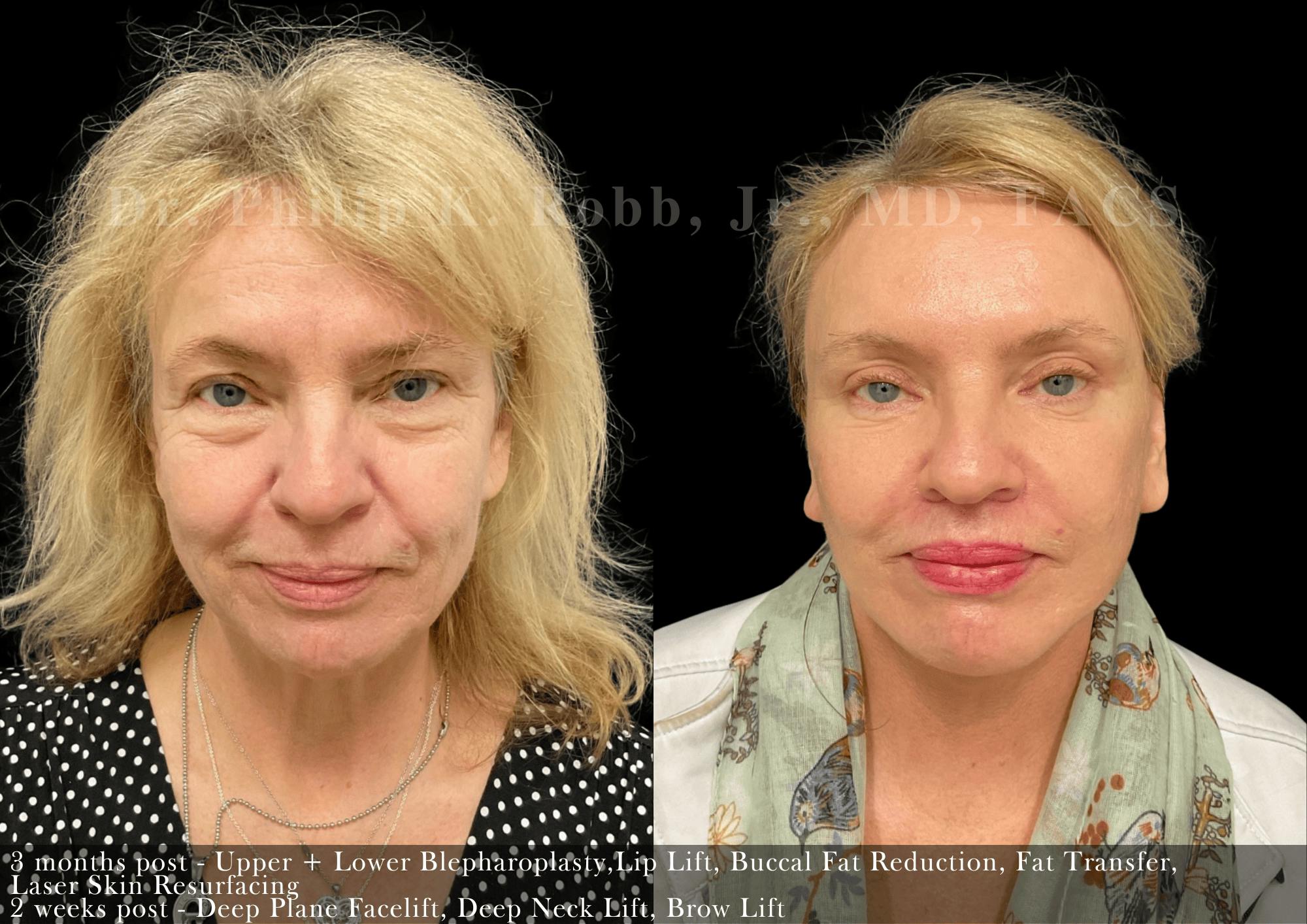 Face Before & After Gallery - Patient 525707 - Image 1