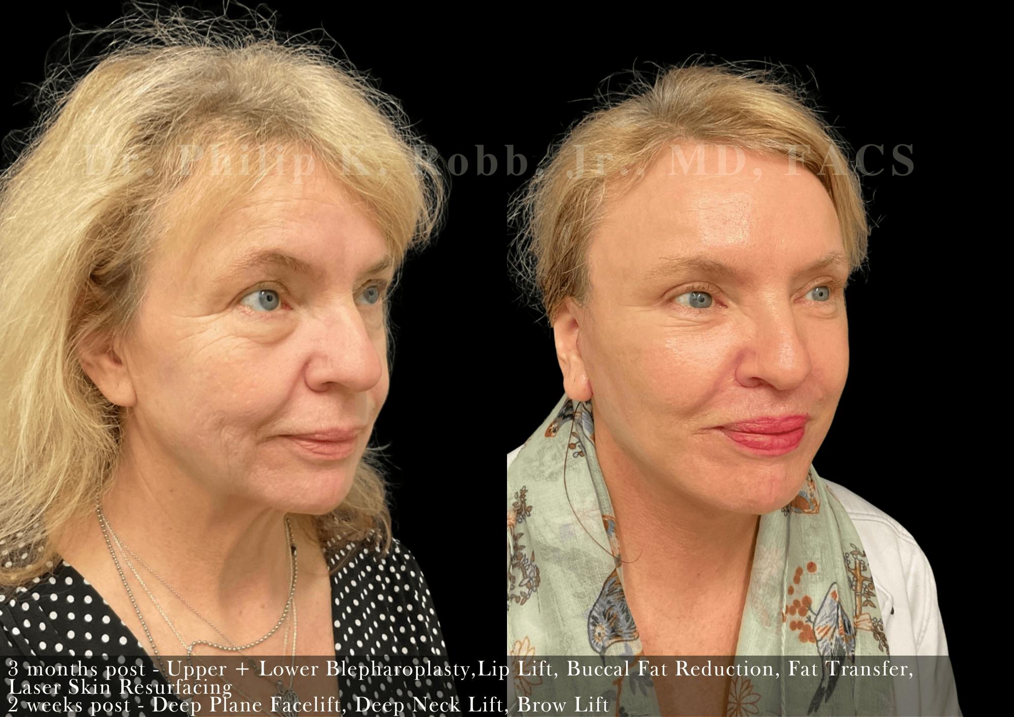 Face Before & After Gallery - Patient 525707 - Image 3