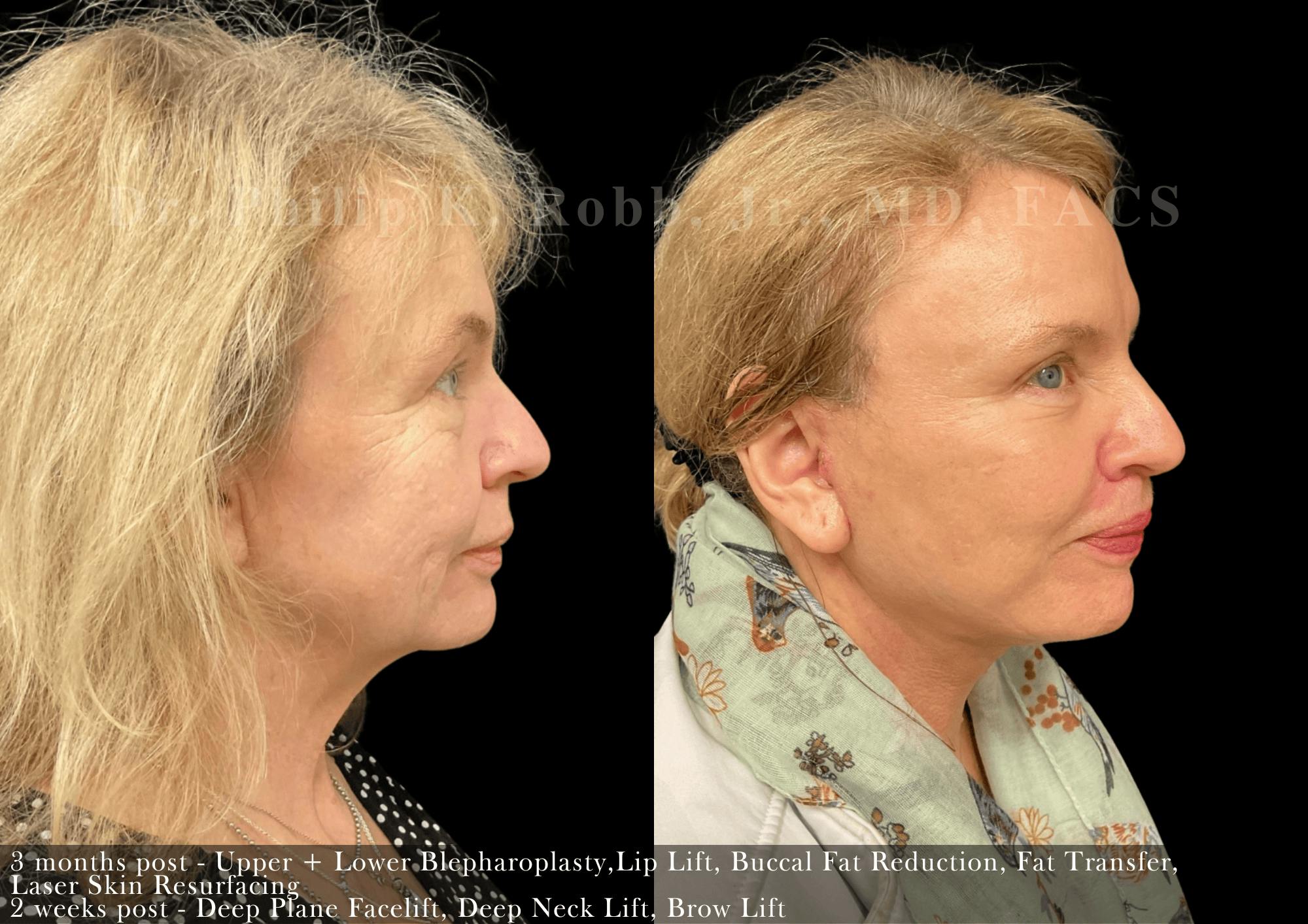 Face Before & After Gallery - Patient 525707 - Image 2