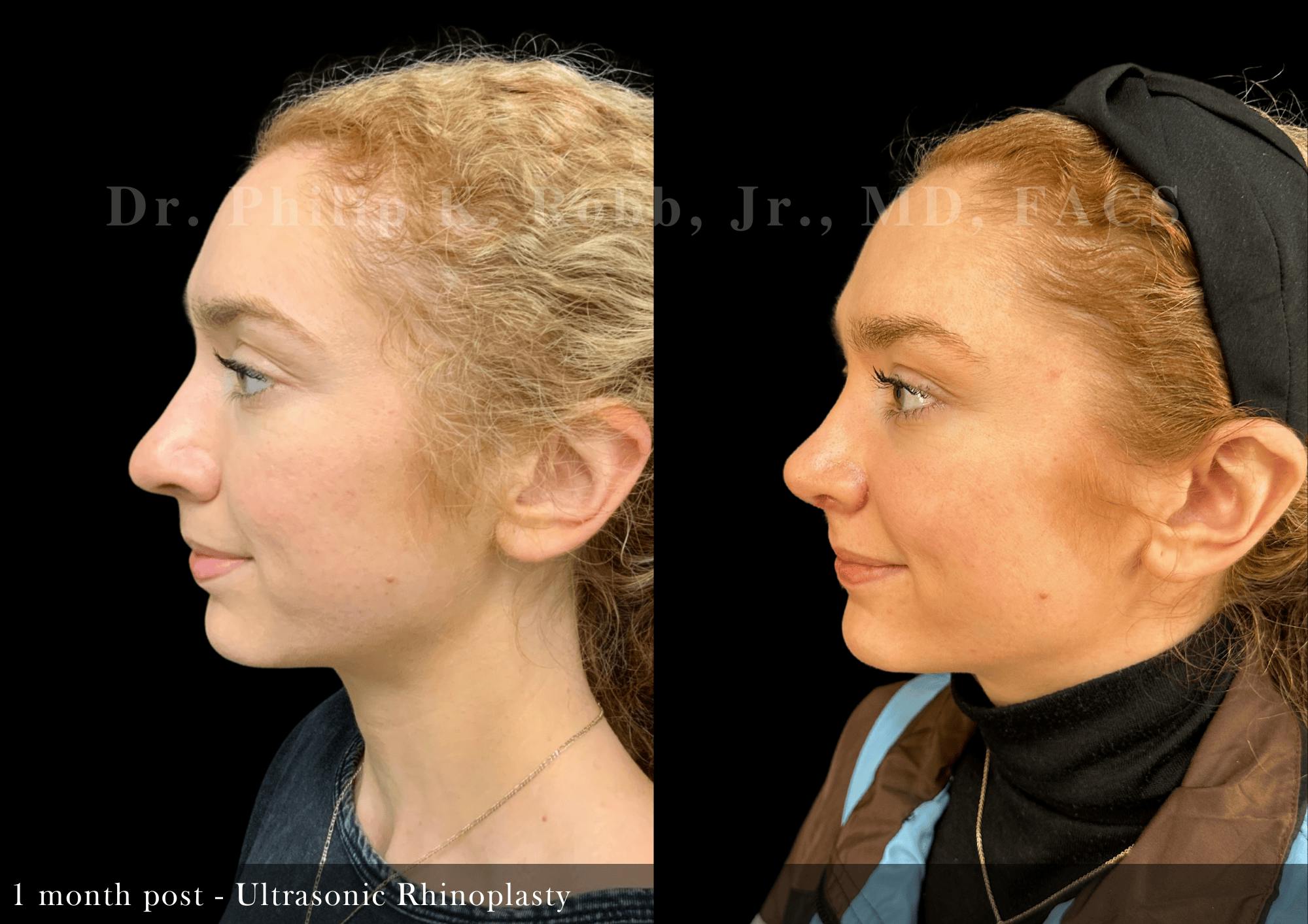 Nose Before & After Gallery - Patient 587148 - Image 5