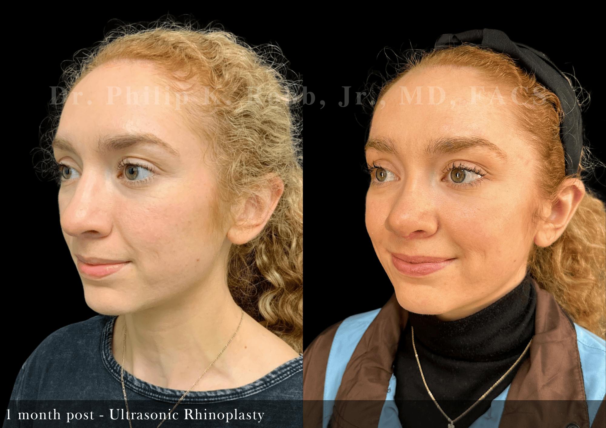 Nose Before & After Gallery - Patient 587148 - Image 4