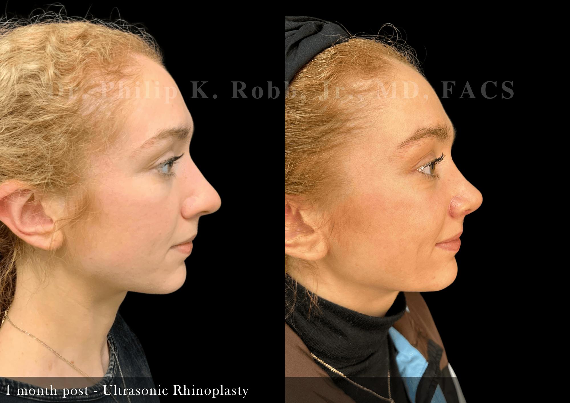 Nose Before & After Gallery - Patient 587148 - Image 1