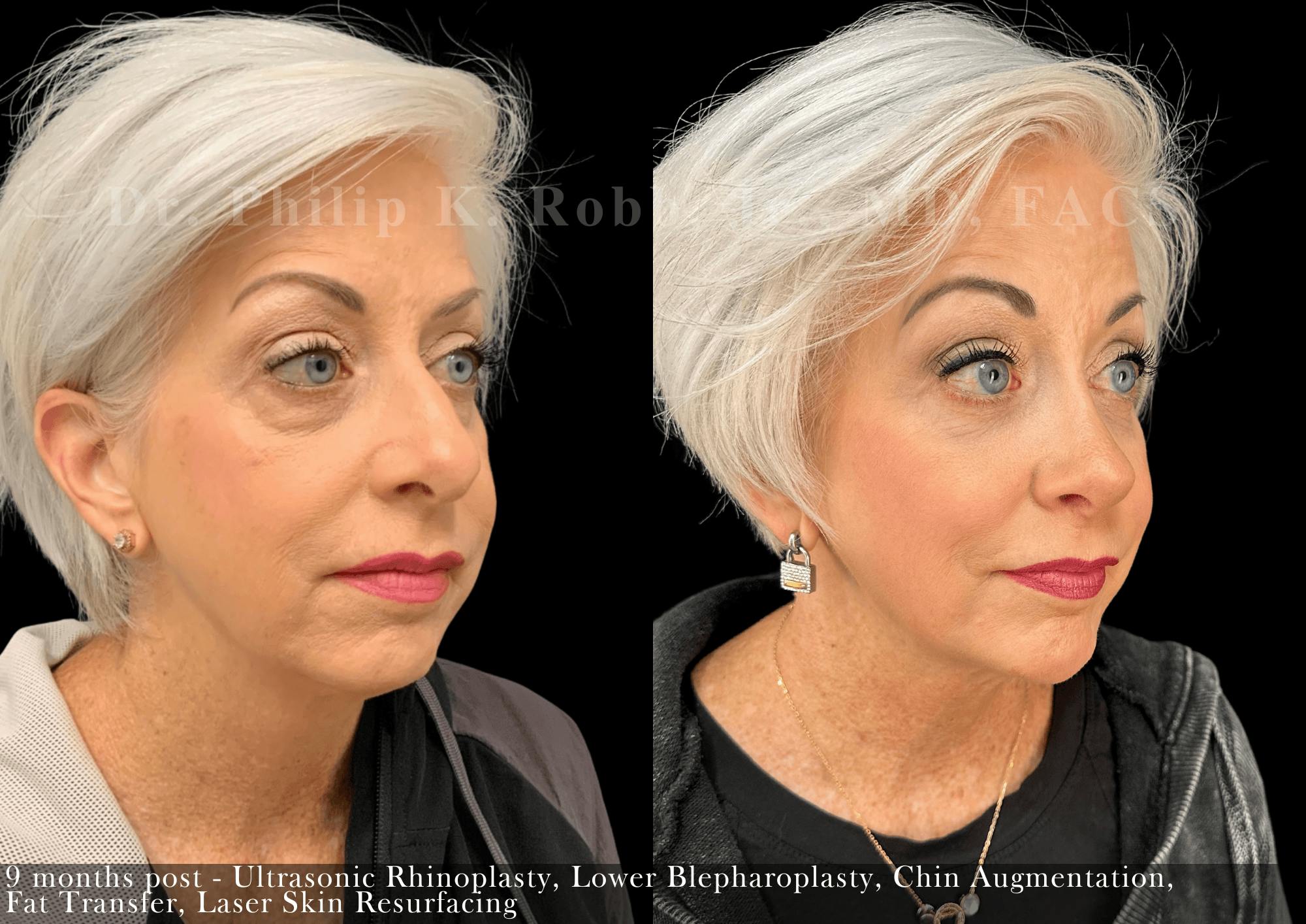 Face Before & After Gallery - Patient 311032 - Image 3