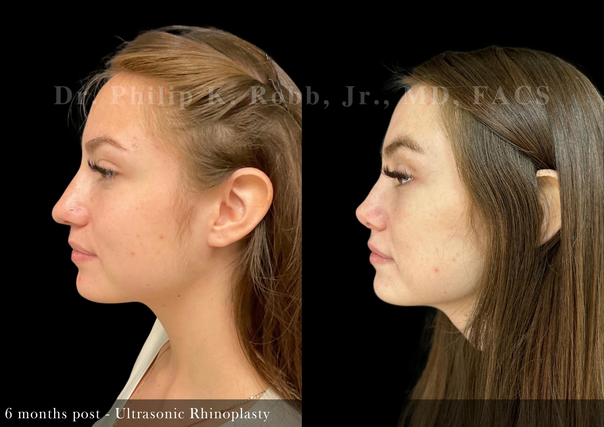 Nose Before & After Gallery - Patient 165444 - Image 4