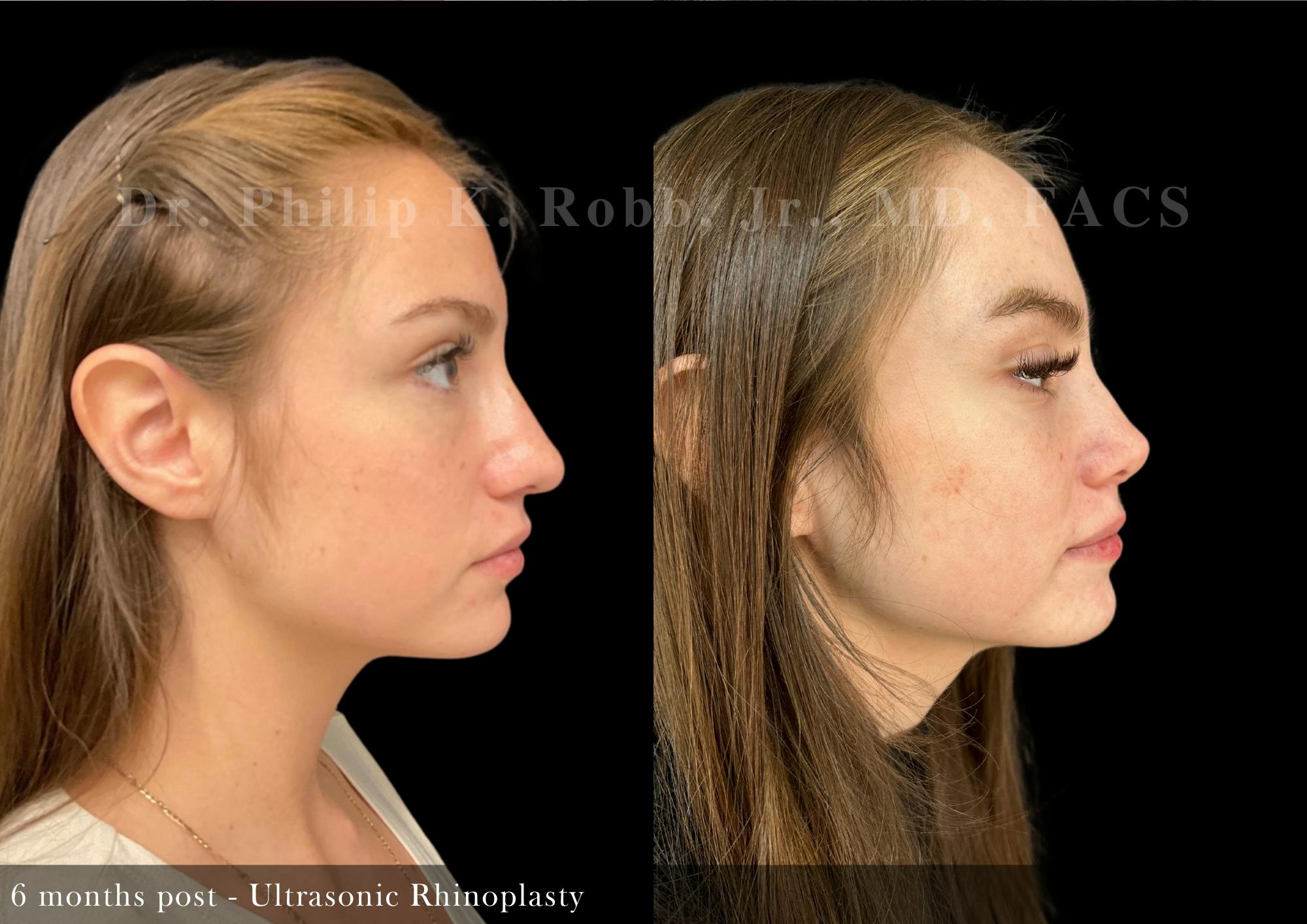 Nose Before & After Gallery - Patient 165444 - Image 1