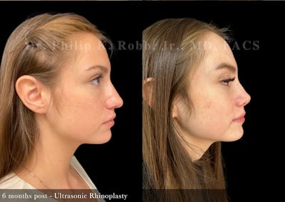 Nose Before & After Gallery - Patient 165444 - Image 1