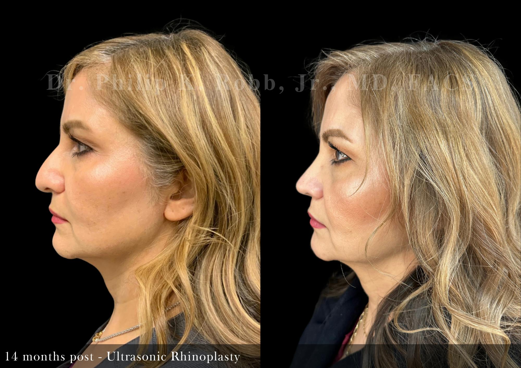 Nose Before & After Gallery - Patient 291016 - Image 4