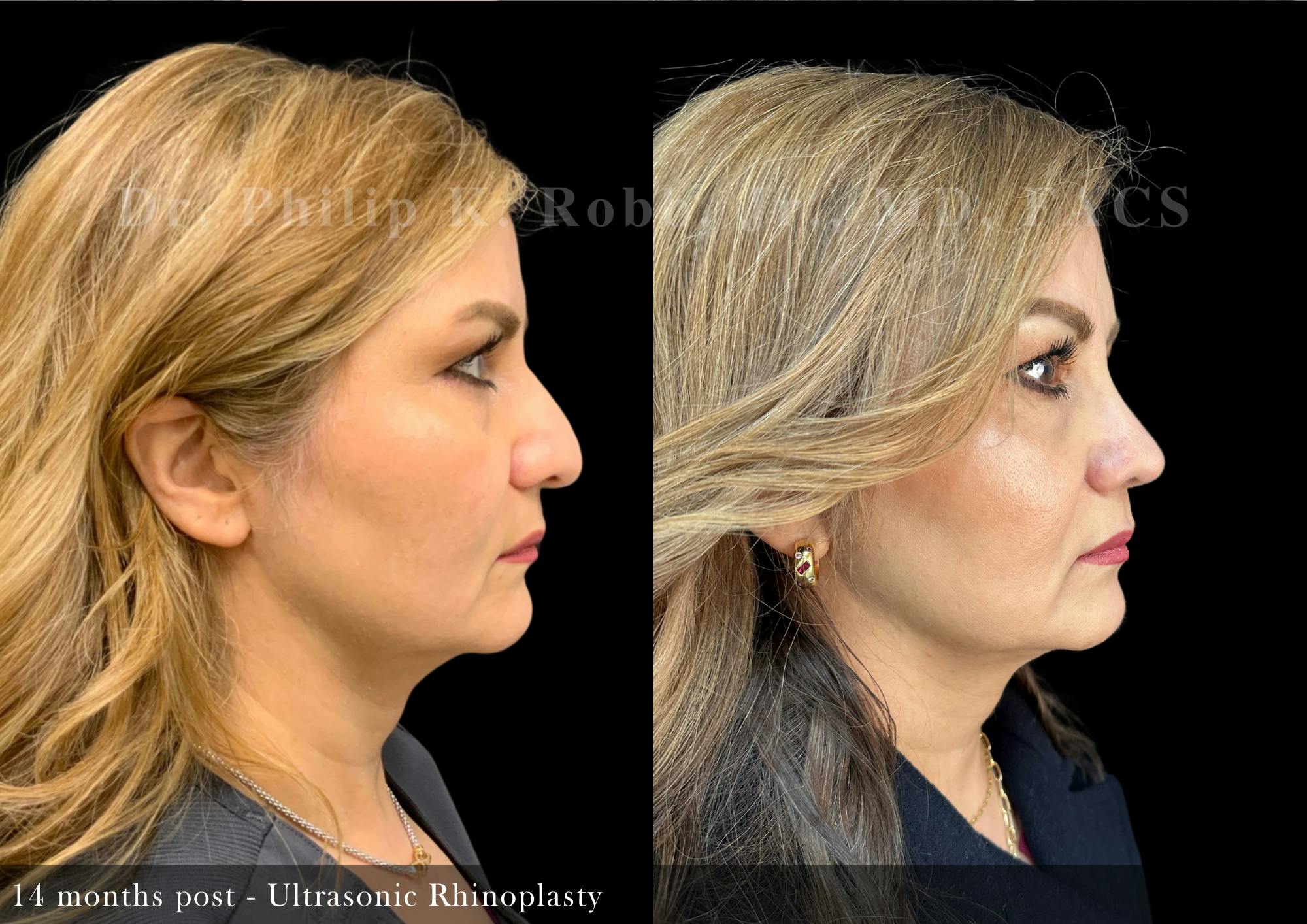Nose Before & After Gallery - Patient 291016 - Image 1