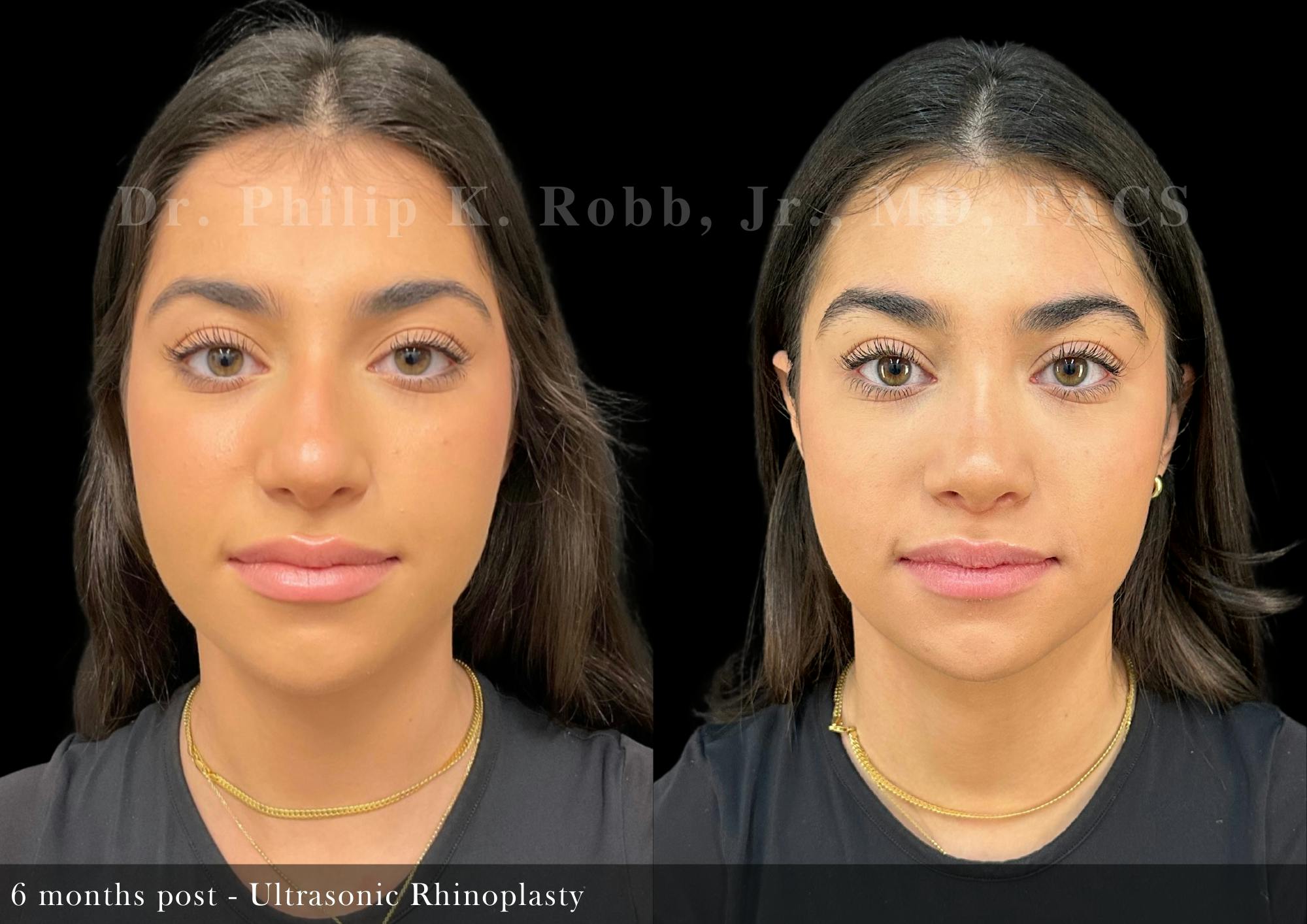 Nose Before & After Gallery - Patient 294104 - Image 3