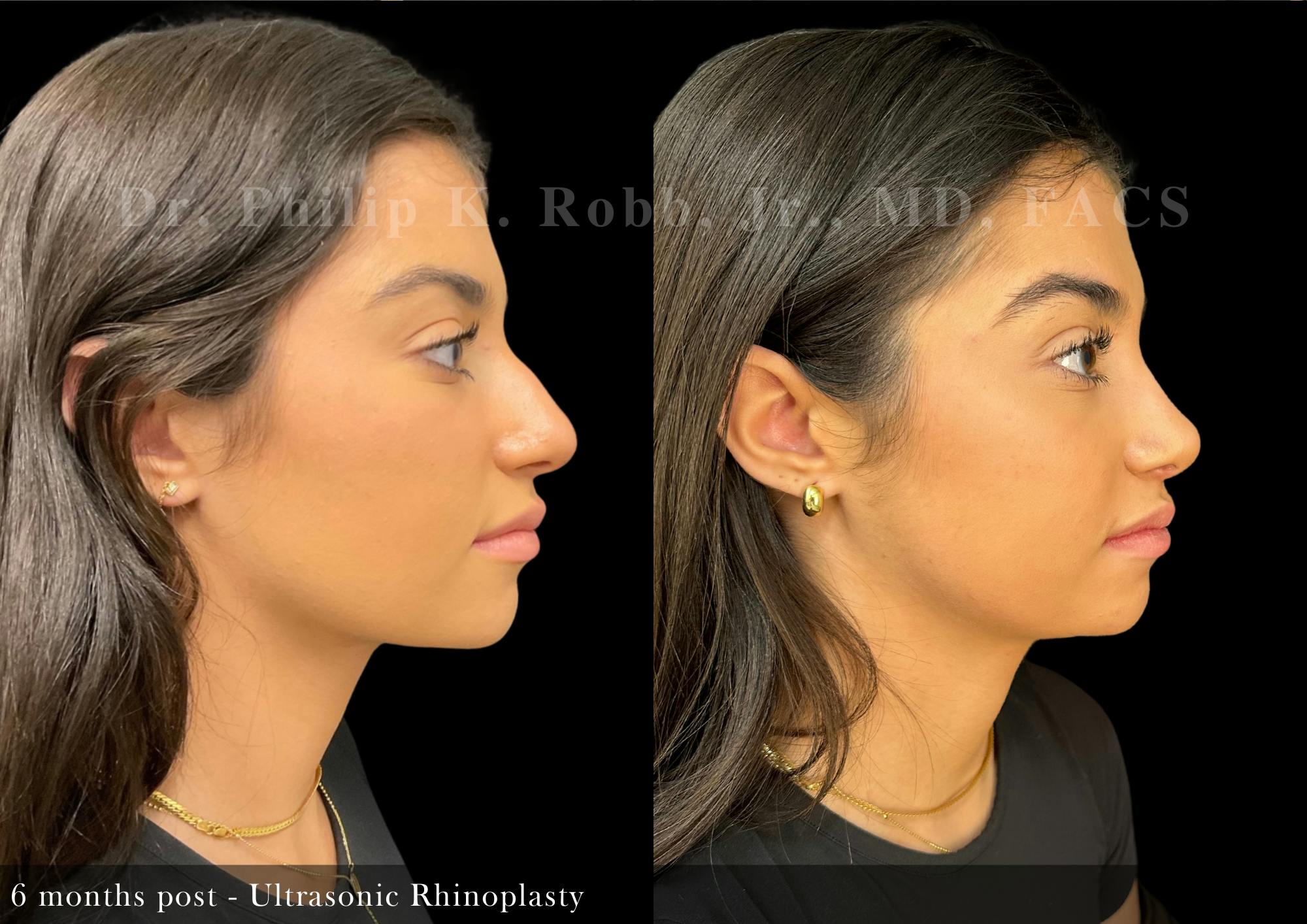Nose Before & After Gallery - Patient 294104 - Image 1
