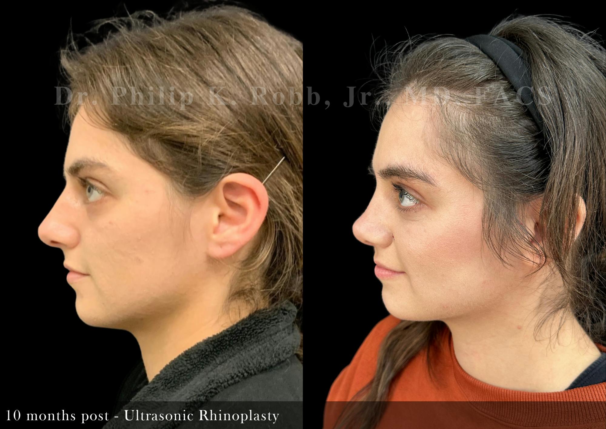 Nose Before & After Gallery - Patient 146203 - Image 4