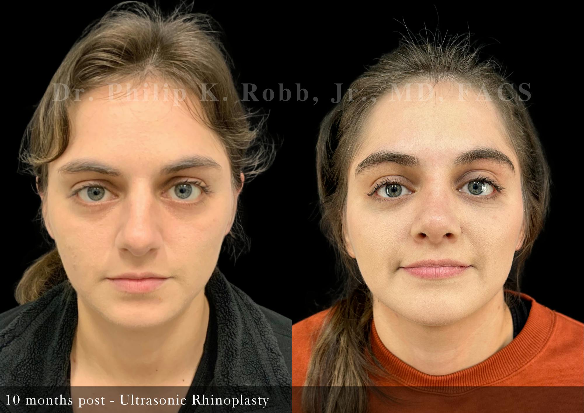 Nose Before & After Gallery - Patient 146203 - Image 3
