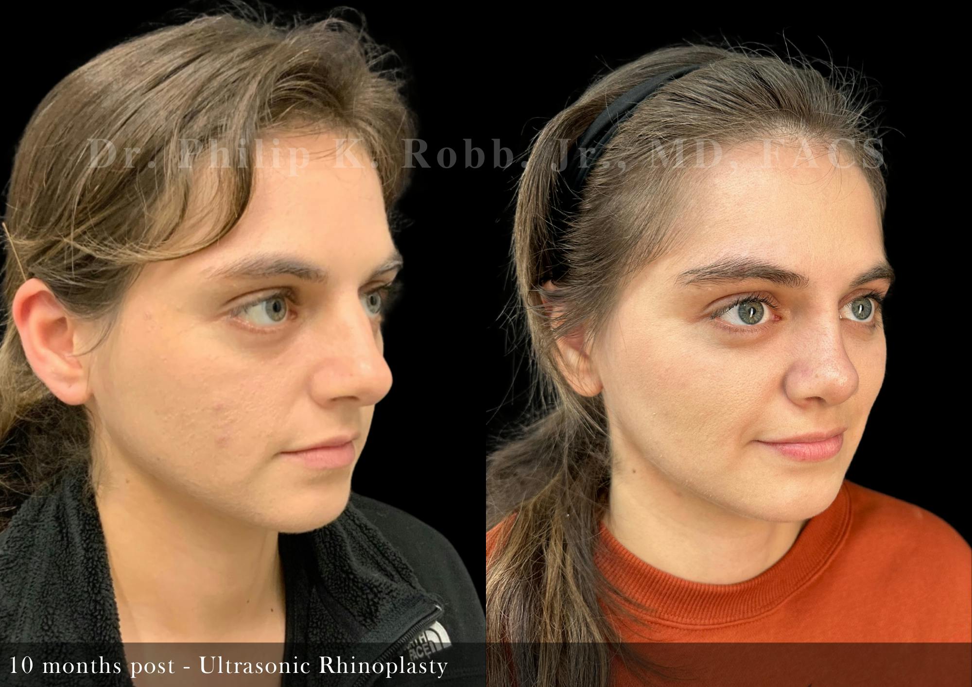 Nose Before & After Gallery - Patient 146203 - Image 2