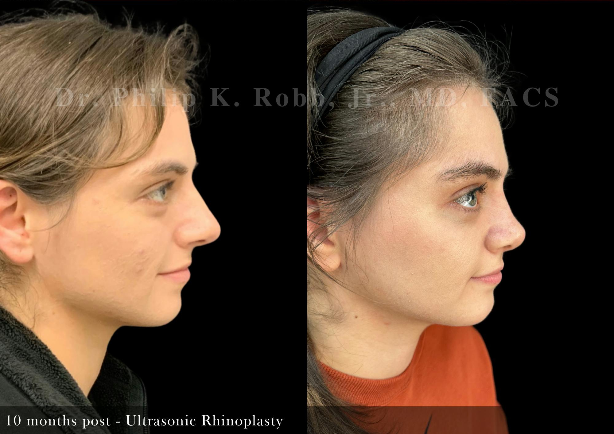 Nose Before & After Gallery - Patient 146203 - Image 1
