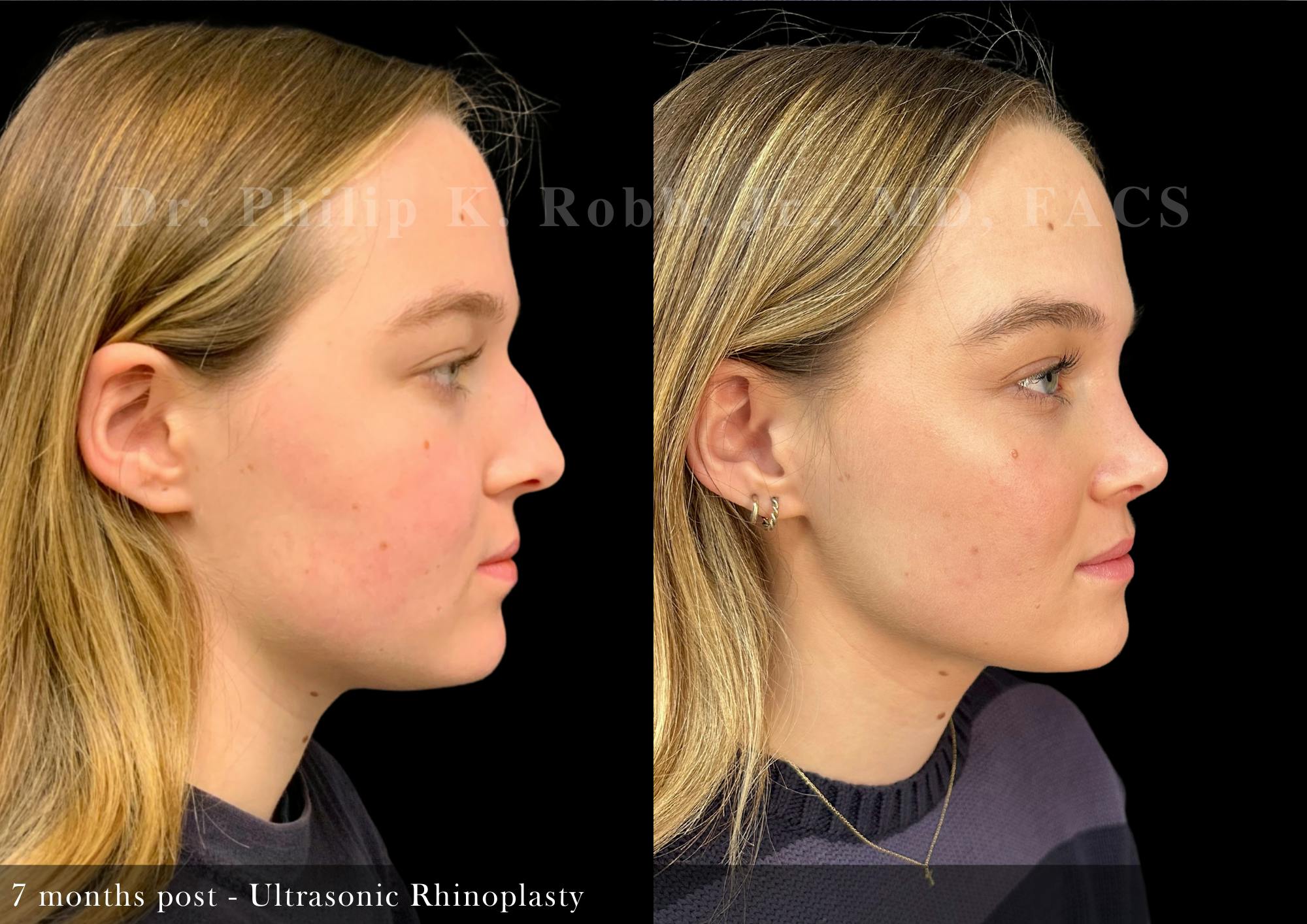 Nose Before & After Gallery - Patient 327210 - Image 1