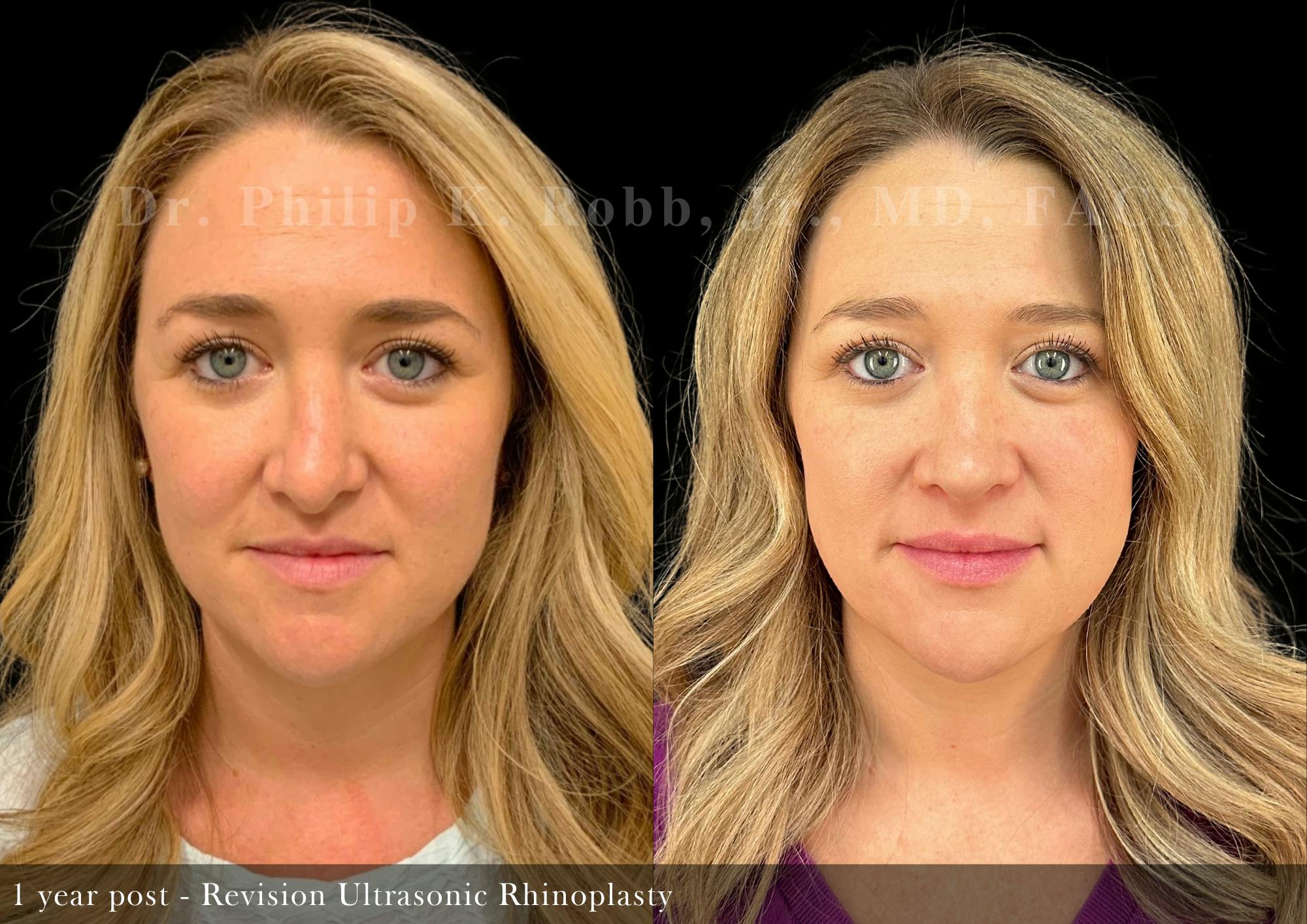 Nose Before & After Gallery - Patient 121266 - Image 3
