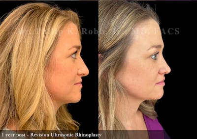 Nose Before & After Gallery - Patient 121266 - Image 1