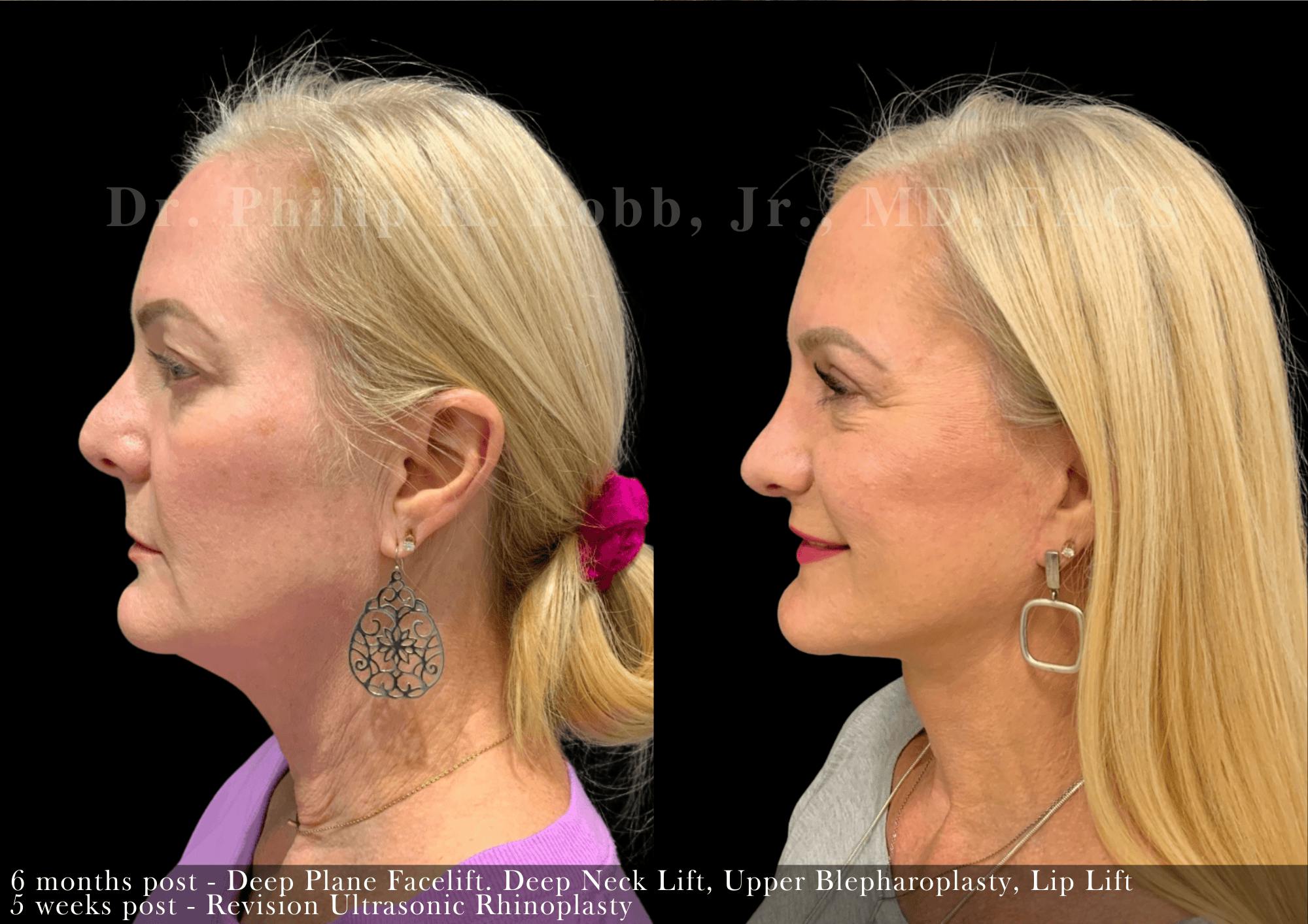 Facelift Before & After Gallery - Patient 137716 - Image 2
