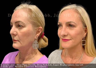 Facelift Before & After Gallery - Patient 137716 - Image 1