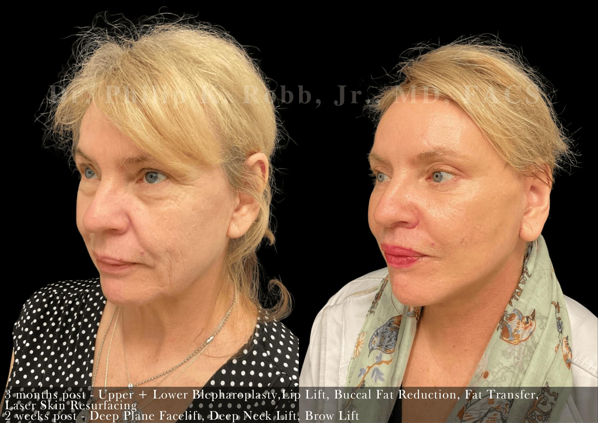 Neck Lift Before & After Gallery - Patient 369715 - Image 4