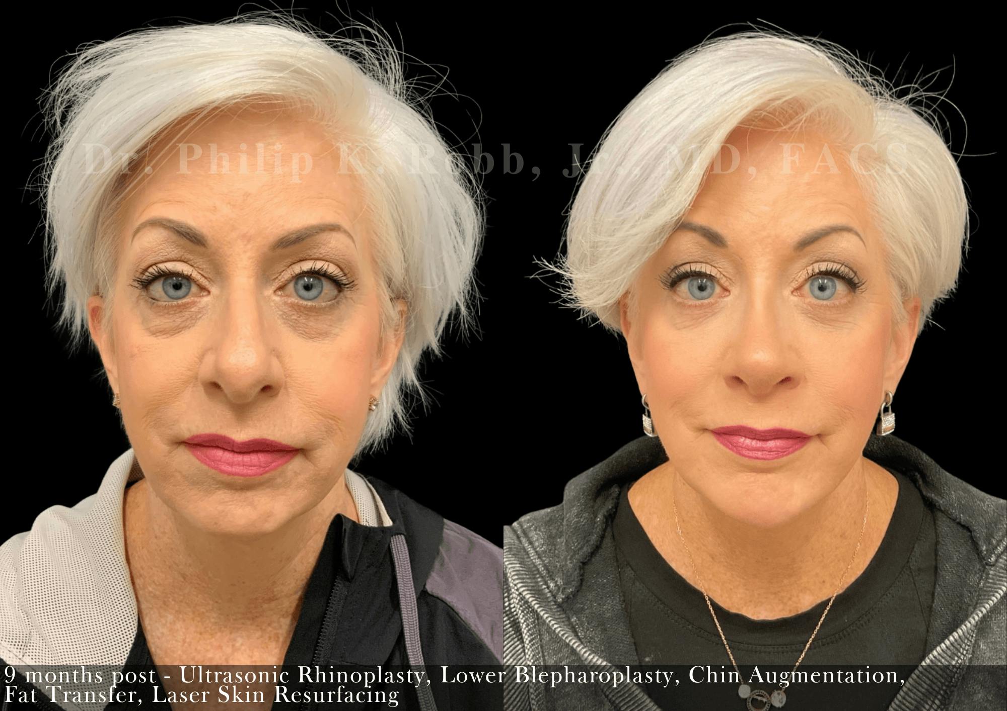 Fat Transfer Before & After Gallery - Patient 237587 - Image 1