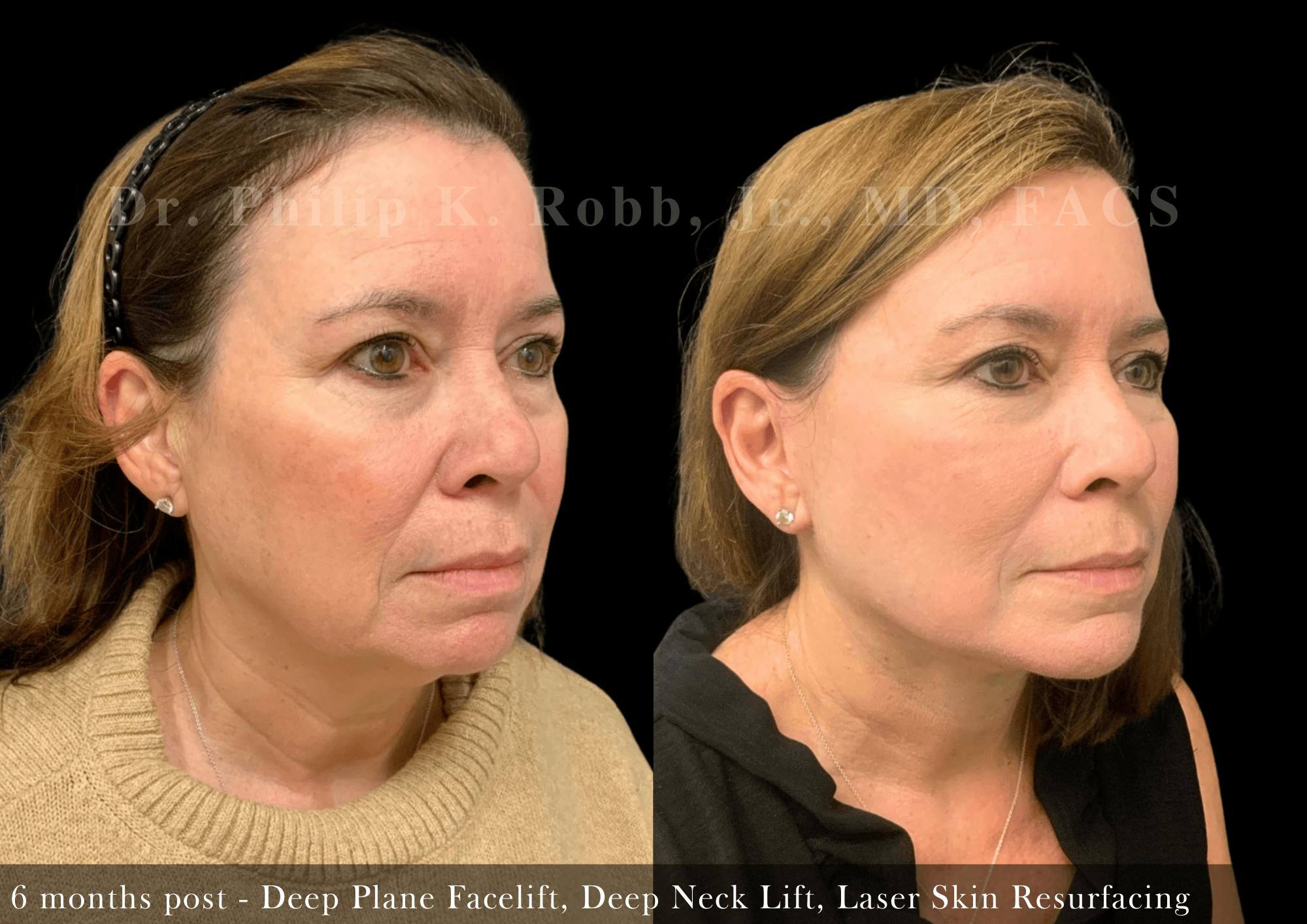 Facelift Before & After Gallery - Patient 245130 - Image 3
