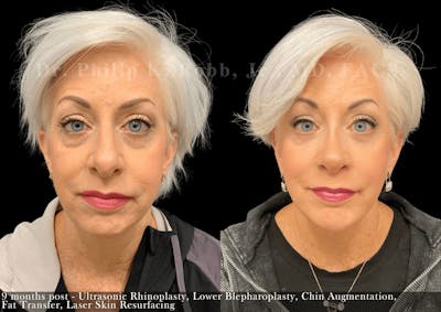 Lower Blepharoplasty Before & After Gallery - Patient 344283 - Image 1