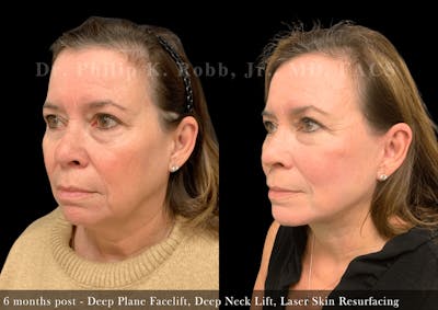 Facelift Before & After Gallery - Patient 245130 - Image 1