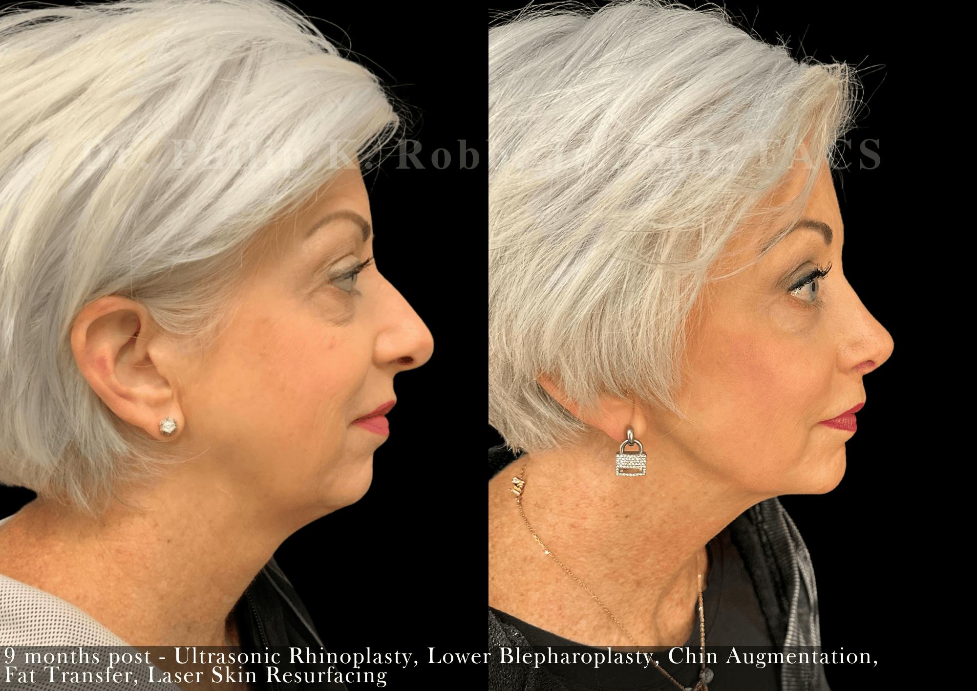 Lower Blepharoplasty Before & After Gallery - Patient 344283 - Image 2