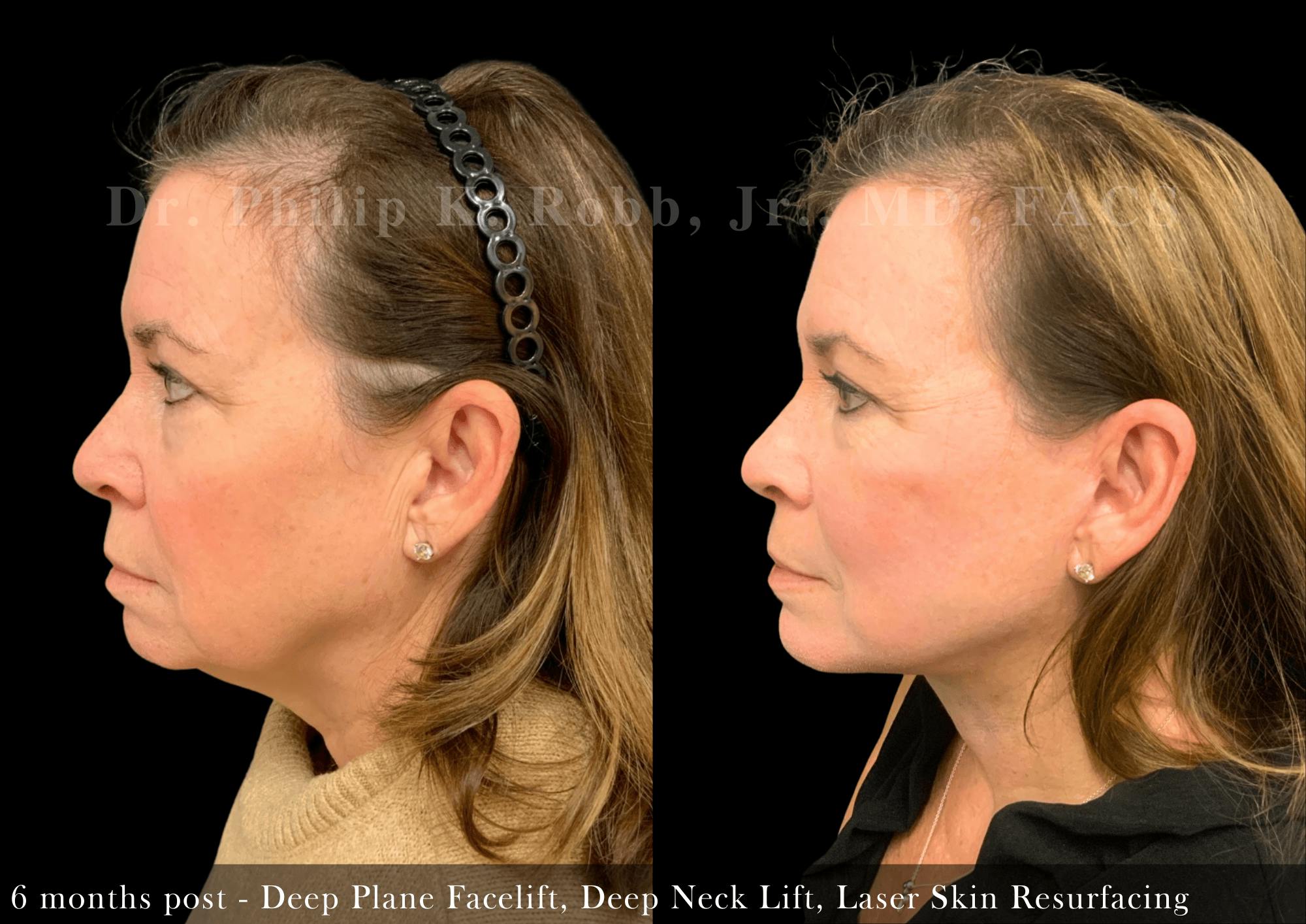 Facelift Before & After Gallery - Patient 245130 - Image 2