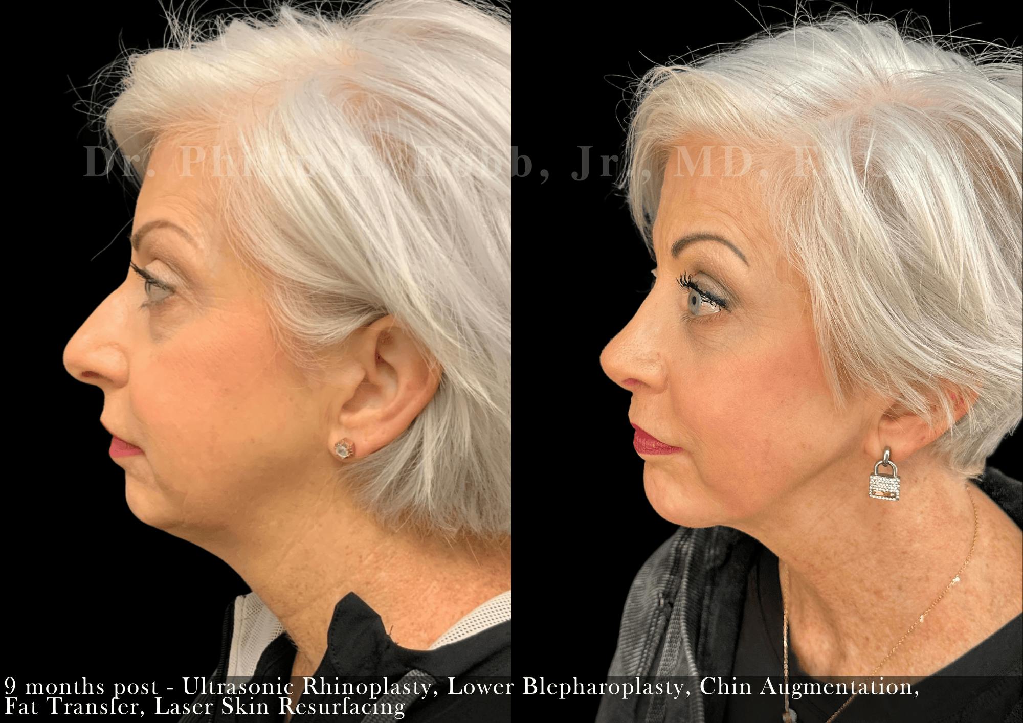 Fat Transfer Before & After Gallery - Patient 237587 - Image 5